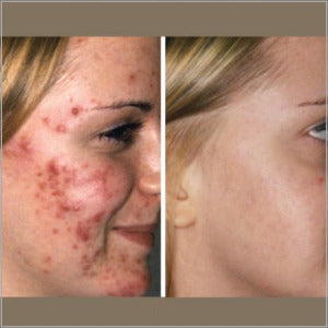 Biophotonic Acne Facial Treatment